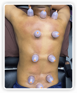 Fisio kedah - Physiotherapy near me - Urut - Bekam - Acupuncture - Sport massage - Jitra fisio - Knee pain - Strok - Sakit belakang