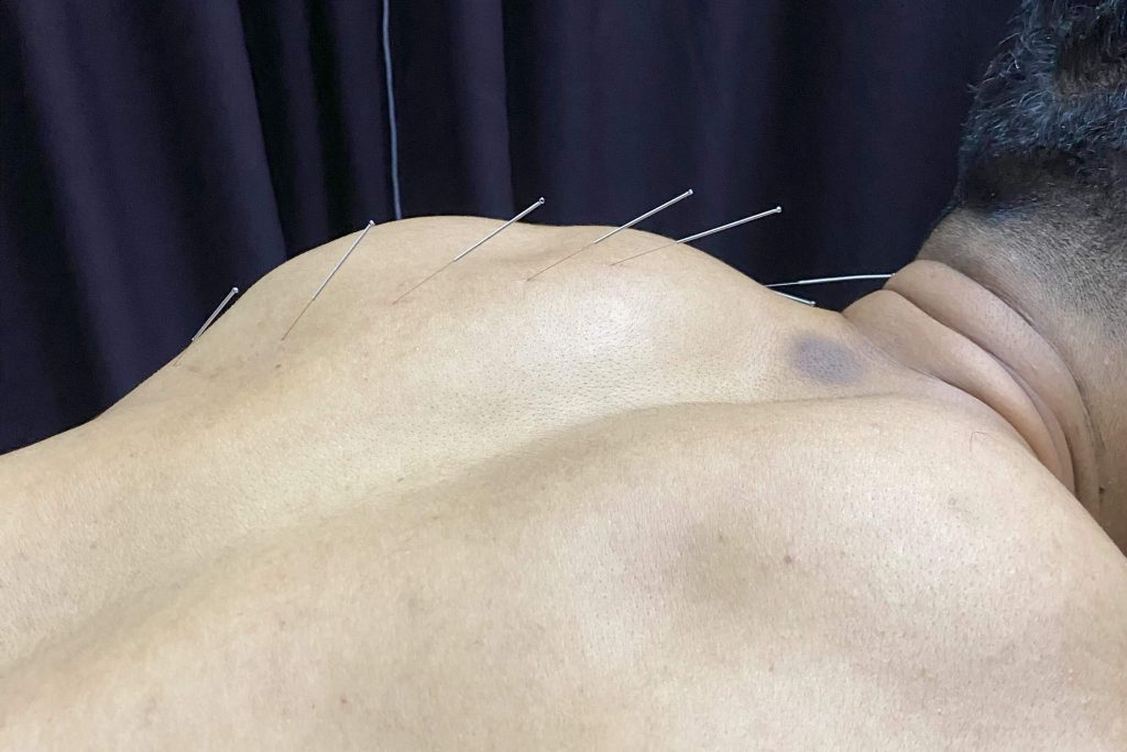 Fisio kedah - Physiotherapy near me - Urut - Bekam - Acupuncture - Sport massage - Jitra fisio - Knee pain - Strok - Sakit belakang